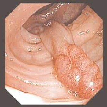 polyp tuyến có cuống (1).png